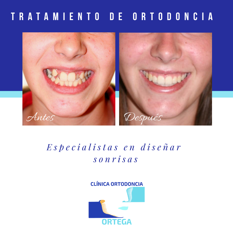 Caso de Clínica Ortodoncia Ortega - Tenerife