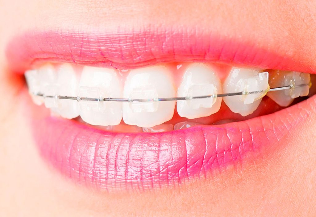Ortodoncia de autoligado estética · Clínica Arturo Ortega en Tenerife