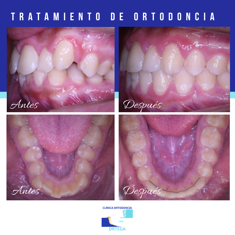 Caso de Clínica Ortodoncia Ortega - Tenerife