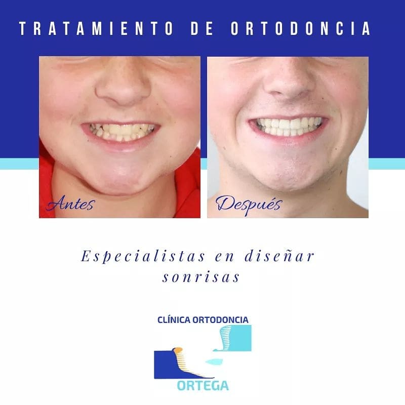 Caso de Clínica Ortodoncia Ortega - Tenerife